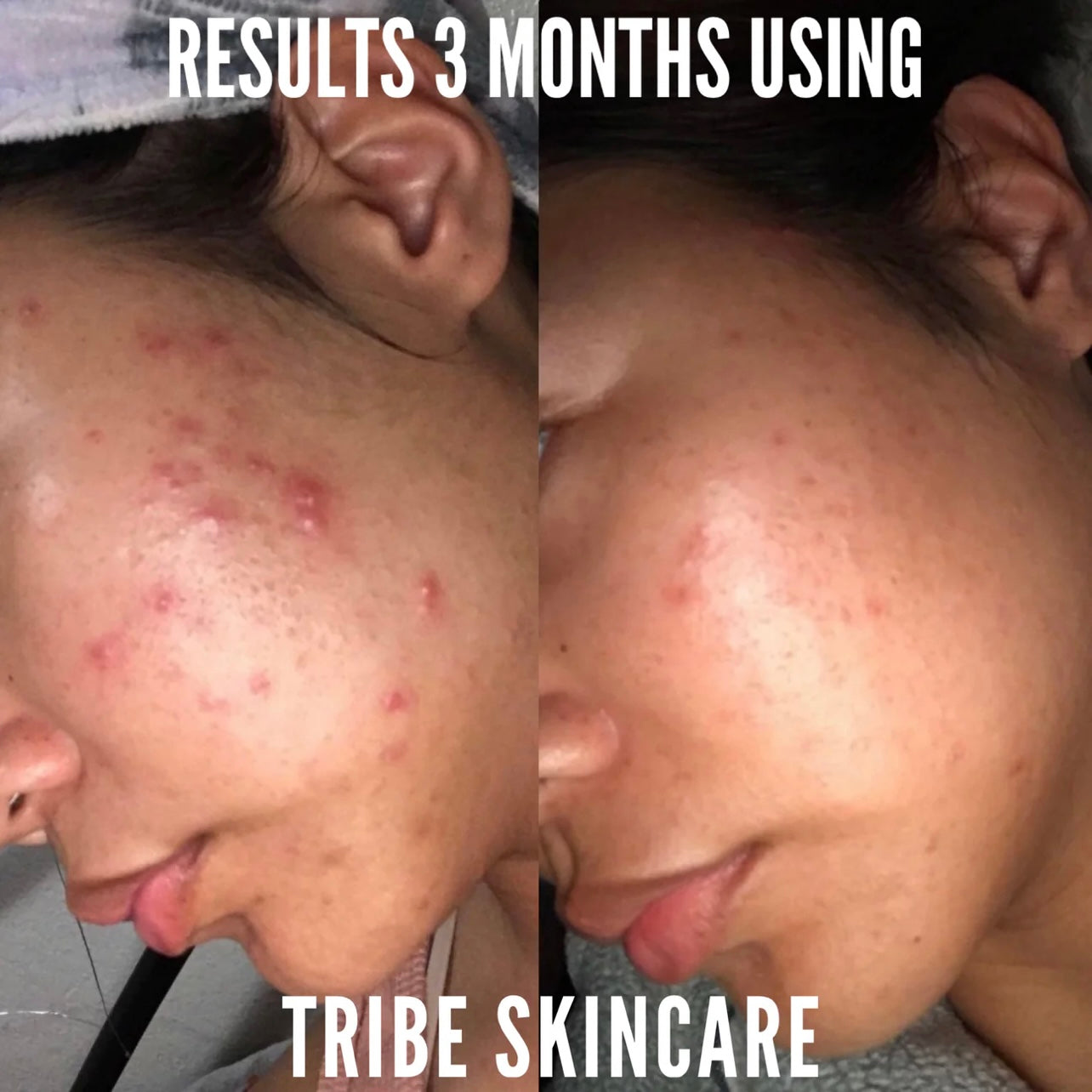 Tribe Clearing Anti-Breakout Serum