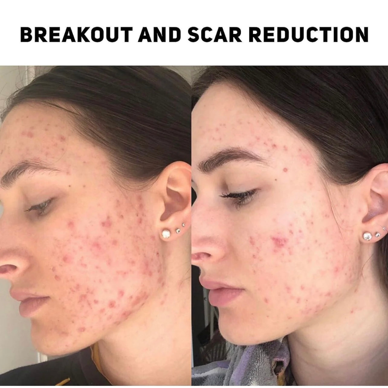 Tribe Clearing Anti-Breakout Serum